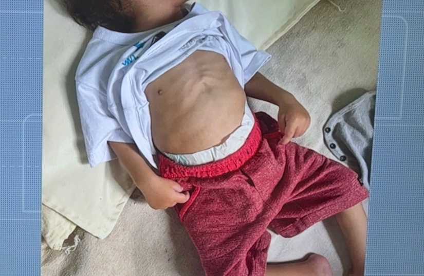 Barra do Choça: Reportagem detalha morte de criança de um ano e cinco meses que morreu por desnutrição