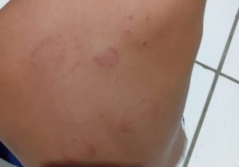 Terrível ataque! Criança de três anos sofre nove mordidas chocantes em creche de Guanambi