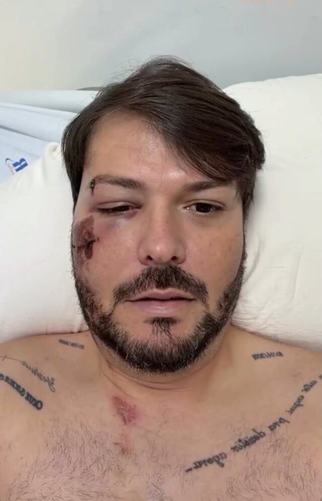 Prefeito de Encruzilhada sofre queda de bicicleta ao atravessar mata-burro e passará por cirurgia no rosto