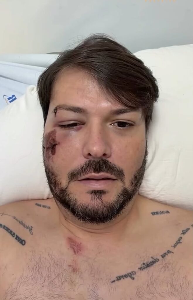 Prefeito de Encruzilhada sofre queda de bicicleta ao atravessar mata-burro e passará por cirurgia no rosto Prefeito de Encruzilhada sofre queda de bicicleta ao atravessar mata-burro e passará por cirurgia no rosto